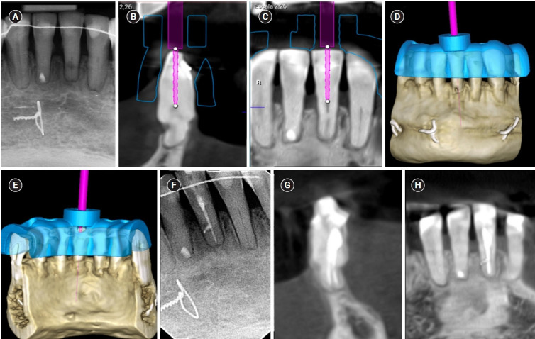 Guided endodontics, precision and predictability: a case series of mineralized anterior teeth with follow-up cone-beam computed tomography.