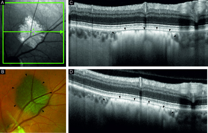 High-resolution optical coherence tomography in pigmented choroidal lesions.