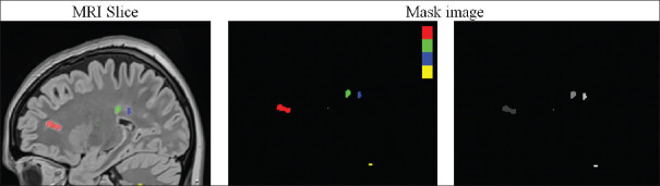 Isfahan Artificial Intelligence Event 2023: Lesion Segmentation and Localization in Magnetic Resonance Images of Patients with Multiple Sclerosis.
