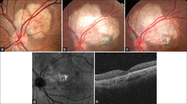 Growing choroidal osteoma: Treated by proton beam radiation.