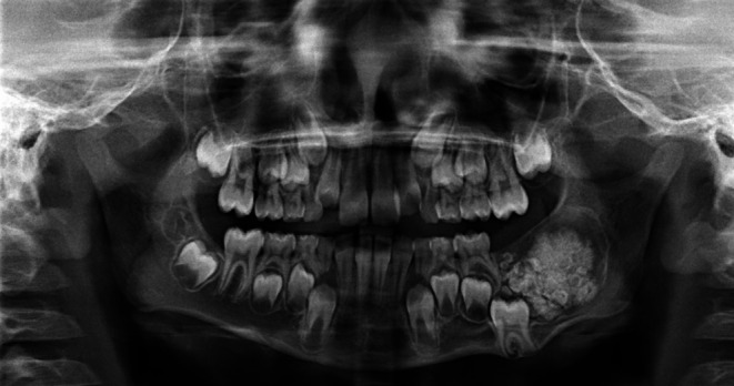 Ameloblastic Fibro-Odontoma with an FGFR1 Mutation: A Case Report.