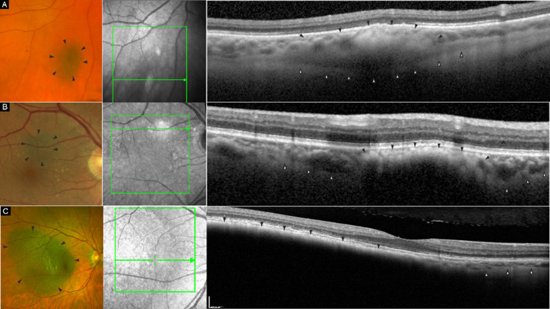 High-resolution optical coherence tomography in pigmented choroidal lesions.