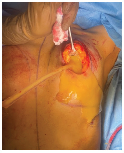 Management of AQUAfilling® Filler Application Complications.