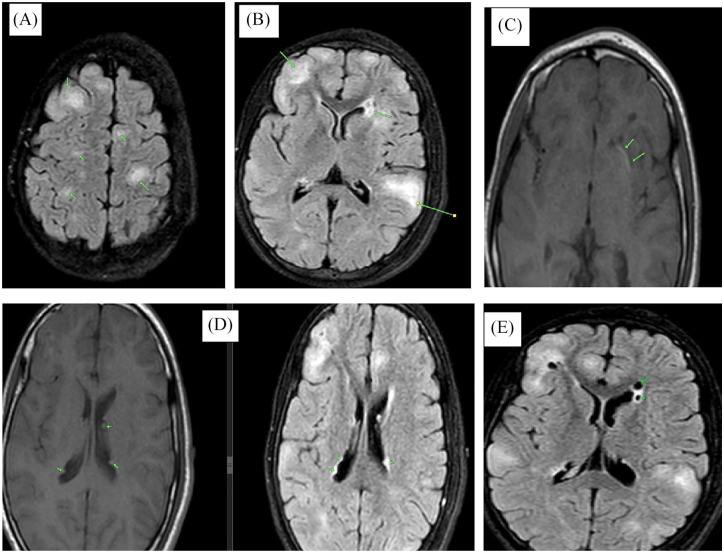 Diagnosis and Management of Tuberous Sclerosis Complex in a Resource-Limited Setting-A Case Report of a 14-Year-Old Female Zambian Adolescent.