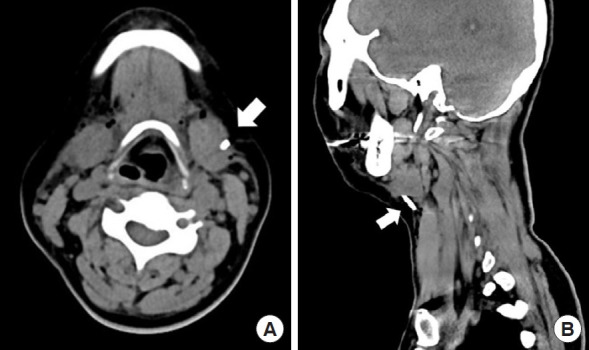 Surgical extraction of a cannula tip embedded in the neck after liposuction at an external facility: a case report.