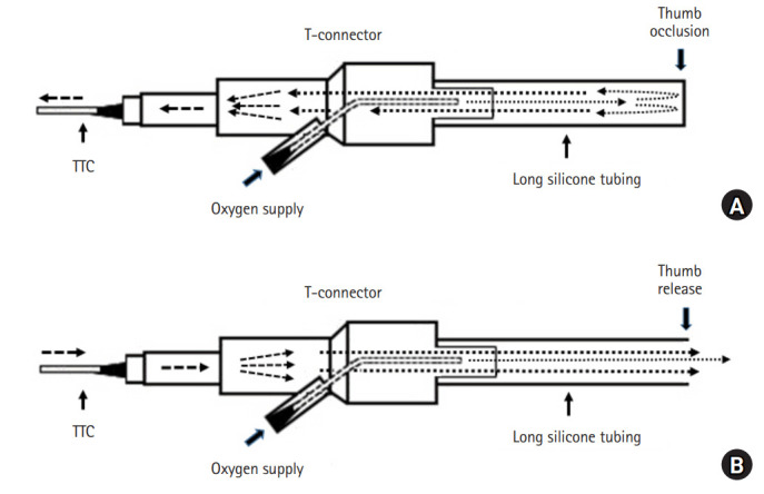 Transcatheter ventilation with a modified Rapid-O2 oxygen insufflation device.