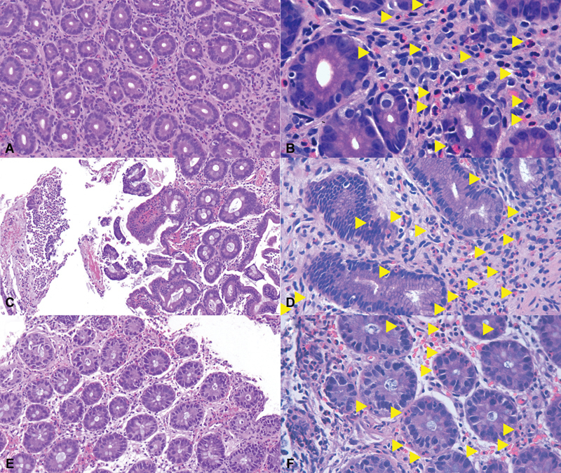 Lower Gastrointestinal Bleeding, Vomiting, and Weight Stagnation in a Well-Appearing Neonate with Neonatal Transient Eosinophilic Gastroenterocolitis.