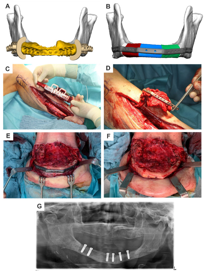 Patient-Specific Solutions for Cranial, Midface, and Mandible Reconstruction Following Ablative Surgery: Expert Opinion and a Consensus on the Guidelines and Workflow.