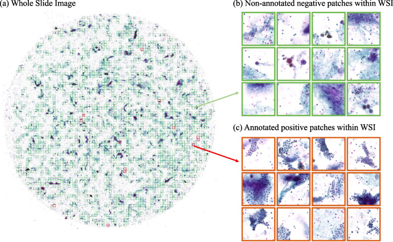Annotation-free genetic mutation estimation of thyroid cancer using cytological slides from multi-centers.