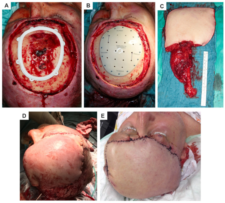 Patient-Specific Solutions for Cranial, Midface, and Mandible Reconstruction Following Ablative Surgery: Expert Opinion and a Consensus on the Guidelines and Workflow.