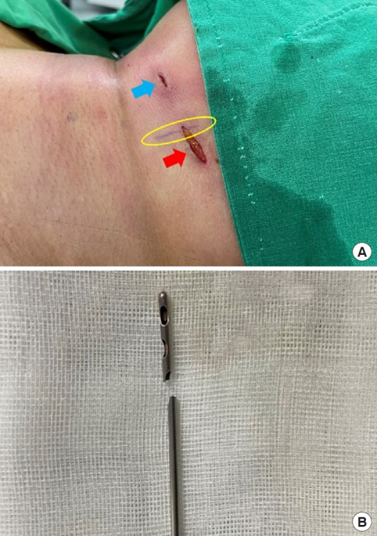 Surgical extraction of a cannula tip embedded in the neck after liposuction at an external facility: a case report.