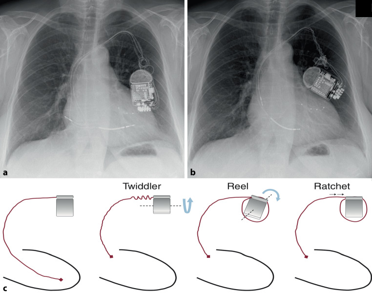 Twists and turns: CRT-D with mixed Twiddler and Reel syndromes.