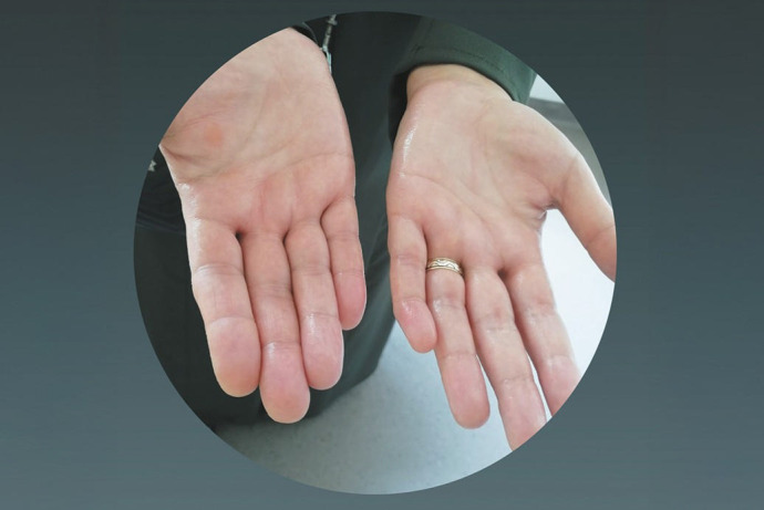 Influence of sex on the outcomes of uniportal video‑assisted thoracoscopic sympathicotomy for primary palmar hyperhidrosis.