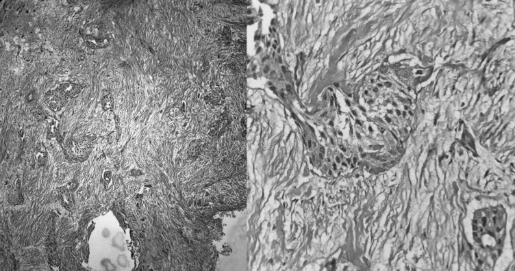 Effective Treatment of Primary Orbital Squamous Cell Carcinoma with Radiotherapy: A Rare Case Report and Literature Review Update.