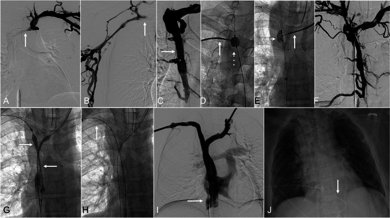 Intermittent Echocardiographic Monitoring During Superior Vena Cava Recanalization: A Protocol for Early Recognition and Management of Hemopericardium.