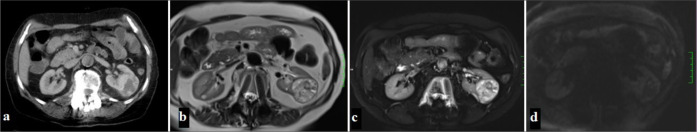 Computed tomography and magnetic resonance imaging characteristics of renal cell carcinoma: Differences between subtypes and clinical evaluation.