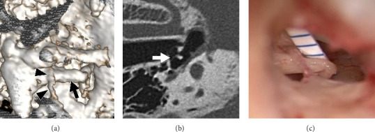 Investigation of the Positional Relationship Between the Tympanic Segment of the Chorda Tympani and the Incus in Patients With Otosclerosis or Middle Ear Anomalies Using Ultra-High Resolution Computed Tomography.