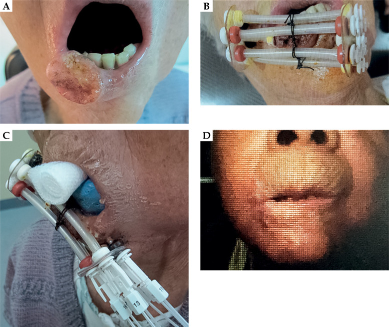 Image-guided high-dose-rate interstitial brachytherapy with custom-made surface applicators for lower lip cancer as monotherapy. Technique, long-term clinical results, and quantitative dose-volume evaluation: A case series.