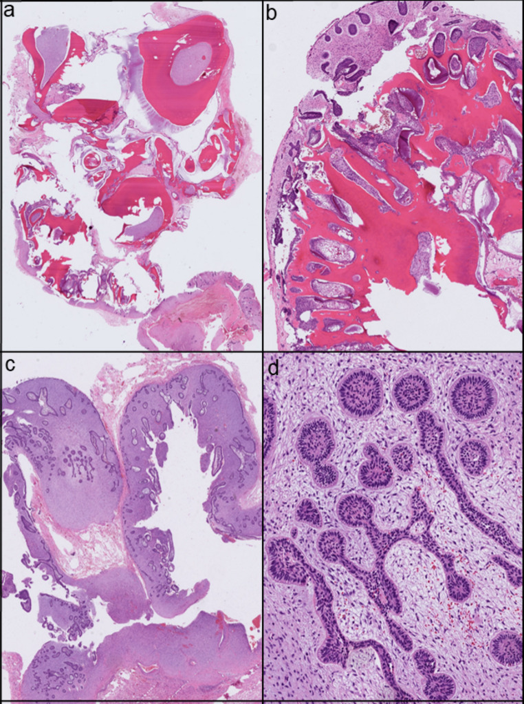 Ameloblastic Fibro-Odontoma with an FGFR1 Mutation: A Case Report.