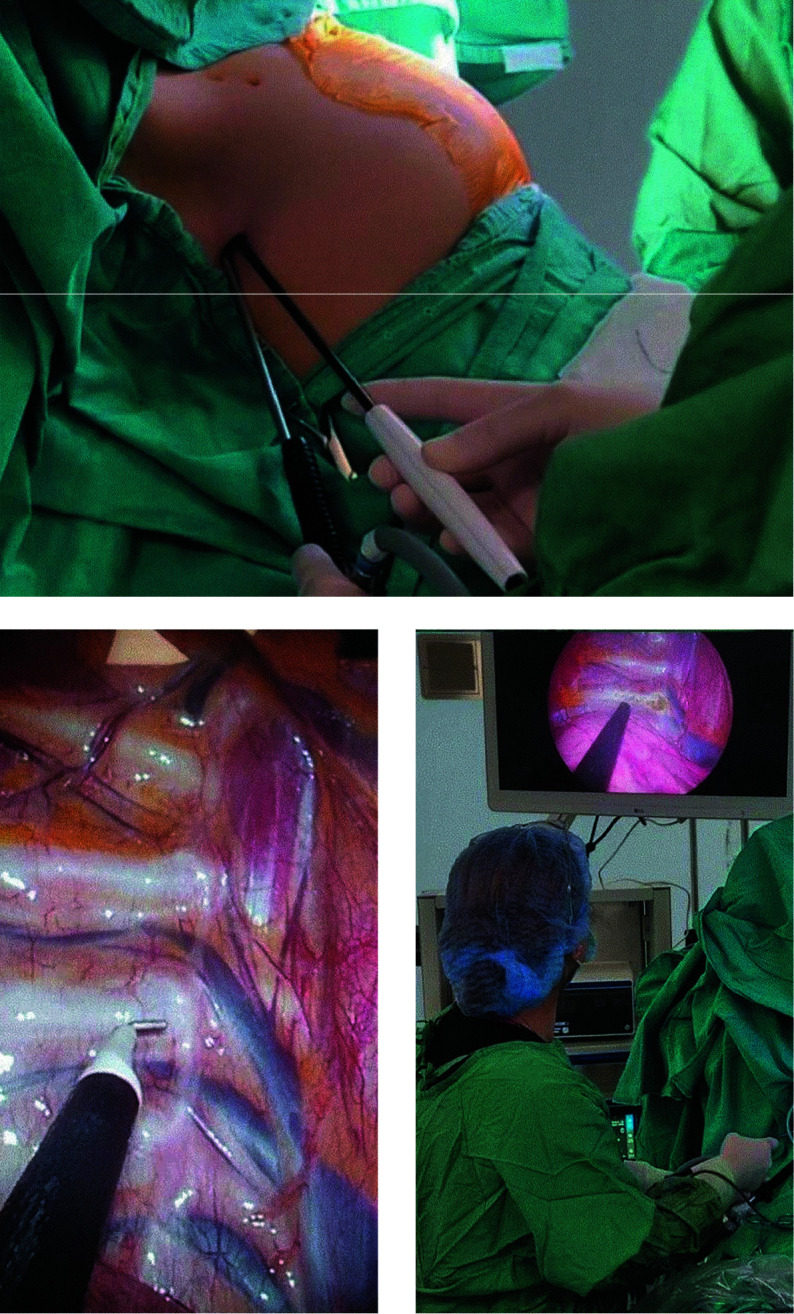 Influence of sex on the outcomes of uniportal video‑assisted thoracoscopic sympathicotomy for primary palmar hyperhidrosis.