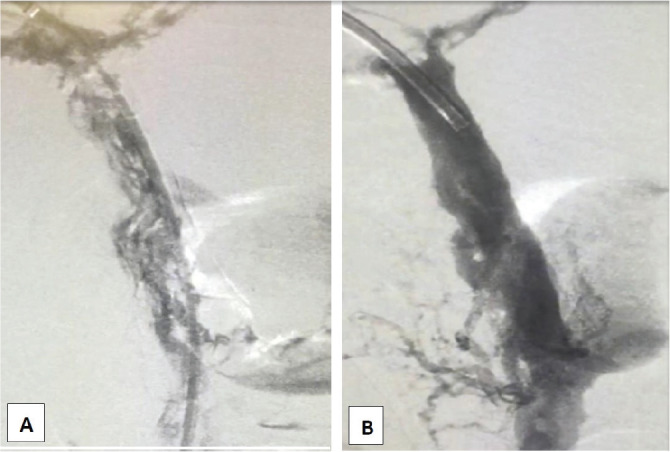 Massive intestinal mesenteric portal vein ischemia: Percutaneous endovascular thrombolysis as minimally invasive step-up approach.