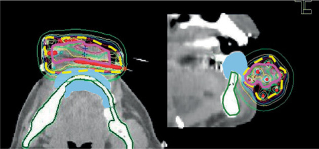 Image-guided high-dose-rate interstitial brachytherapy with custom-made surface applicators for lower lip cancer as monotherapy. Technique, long-term clinical results, and quantitative dose-volume evaluation: A case series.