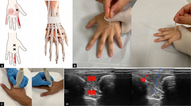 An overlooked cause of hand pain: myofascial trigger points in the interosseous muscles.