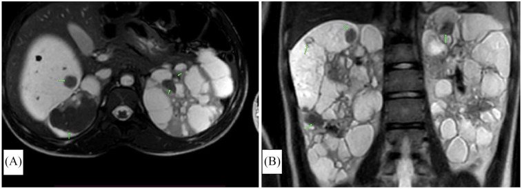 Diagnosis and Management of Tuberous Sclerosis Complex in a Resource-Limited Setting-A Case Report of a 14-Year-Old Female Zambian Adolescent.
