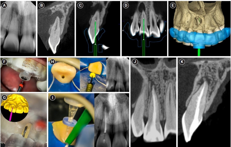 Guided endodontics, precision and predictability: a case series of mineralized anterior teeth with follow-up cone-beam computed tomography.