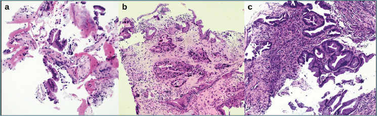 Morpho-molecular approach (NGS <i>plus</i> digital PCR) in diagnosis of malignant biliary strictures.