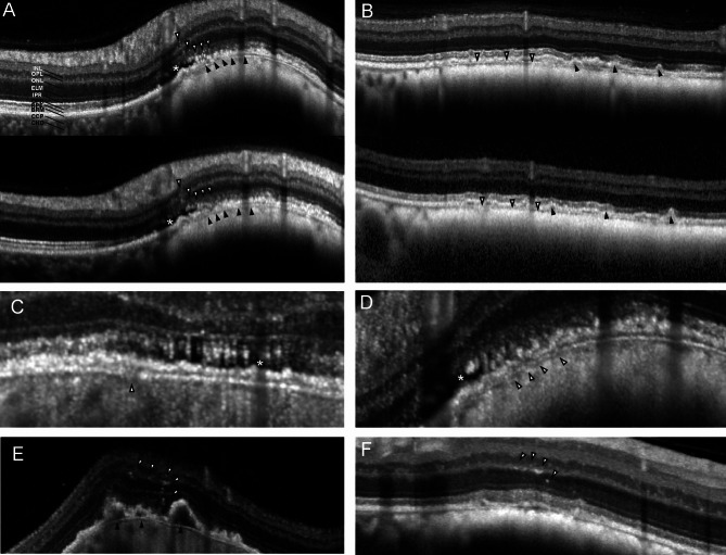 High-resolution optical coherence tomography in pigmented choroidal lesions.