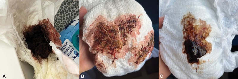 Lower Gastrointestinal Bleeding, Vomiting, and Weight Stagnation in a Well-Appearing Neonate with Neonatal Transient Eosinophilic Gastroenterocolitis.