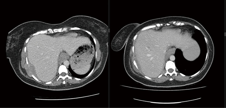 A woman with a pleural mesothelioma and an inherited <i>ATM</i> mutation-a case report.