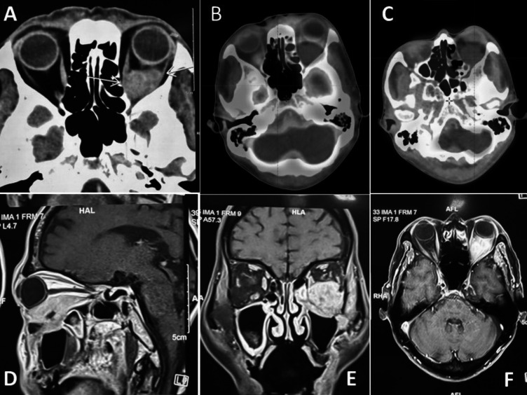 Effective Treatment of Primary Orbital Squamous Cell Carcinoma with Radiotherapy: A Rare Case Report and Literature Review Update.