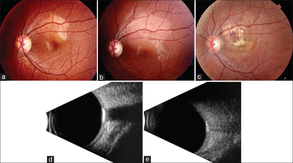 Growing choroidal osteoma: Treated by proton beam radiation.