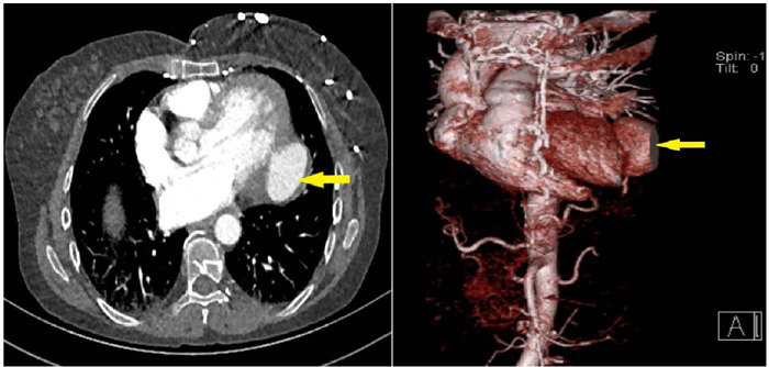 Repair of Left Ventricular Pseudoaneurysm Due to Systemic Lupus Erythematosus.