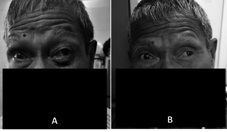 Effective Treatment of Primary Orbital Squamous Cell Carcinoma with Radiotherapy: A Rare Case Report and Literature Review Update.