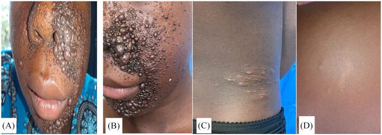 Diagnosis and Management of Tuberous Sclerosis Complex in a Resource-Limited Setting-A Case Report of a 14-Year-Old Female Zambian Adolescent.