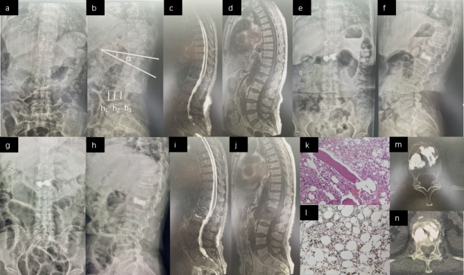 Risk factor analysis of adjacent vertebral compression fracture following the surgery of percutaneous kyphoplasty in postmenopausal women.