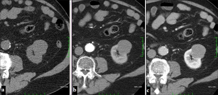 Computed tomography and magnetic resonance imaging characteristics of renal cell carcinoma: Differences between subtypes and clinical evaluation.