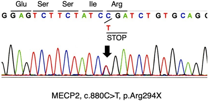 Rett syndrome complicated by diabetes mellitus type 1.