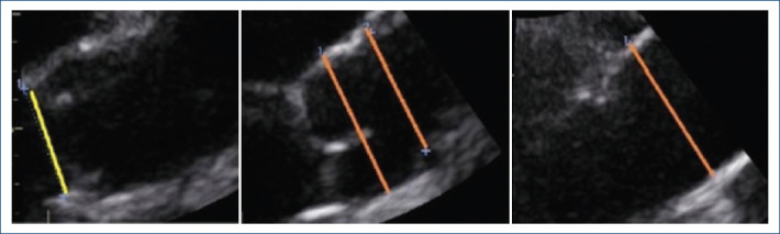Sex-specific considerations in defining aortic dilation: findings from the MATEAR study.