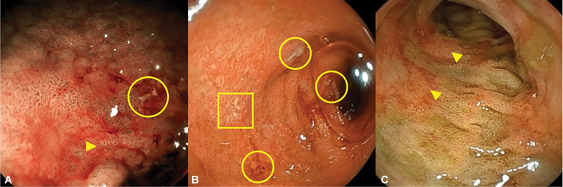 Lower Gastrointestinal Bleeding, Vomiting, and Weight Stagnation in a Well-Appearing Neonate with Neonatal Transient Eosinophilic Gastroenterocolitis.