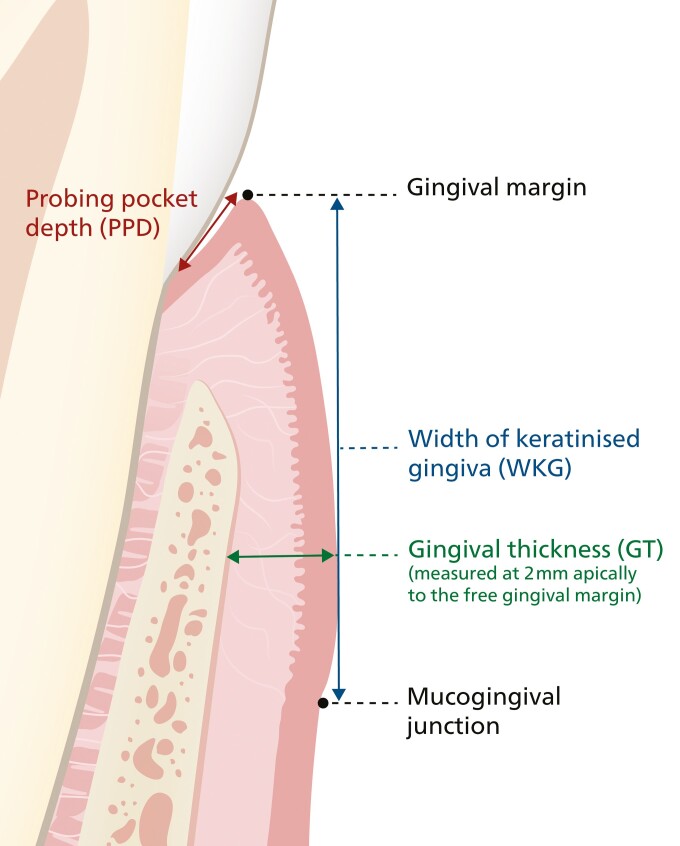 Does incisor inclination change during orthodontic treatment affect gingival thickness and the width of keratinized gingiva? A prospective controlled study.