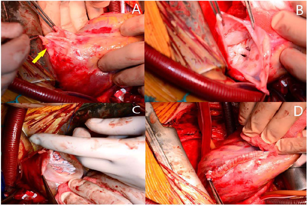 Repair of Left Ventricular Pseudoaneurysm Due to Systemic Lupus Erythematosus.