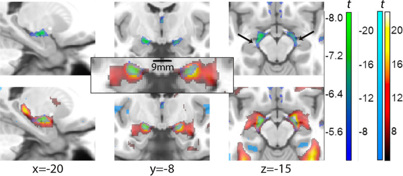Functional imaging of time on task and habituation in passive exposure to faces with emotional expression.