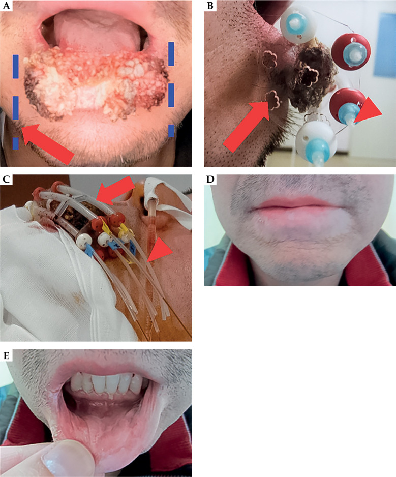 Image-guided high-dose-rate interstitial brachytherapy with custom-made surface applicators for lower lip cancer as monotherapy. Technique, long-term clinical results, and quantitative dose-volume evaluation: A case series.