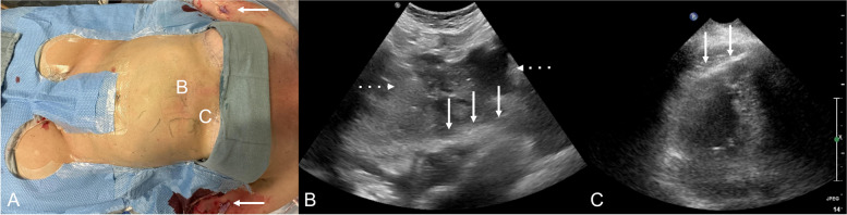 Intermittent Echocardiographic Monitoring During Superior Vena Cava Recanalization: A Protocol for Early Recognition and Management of Hemopericardium.