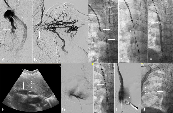 Intermittent Echocardiographic Monitoring During Superior Vena Cava Recanalization: A Protocol for Early Recognition and Management of Hemopericardium.