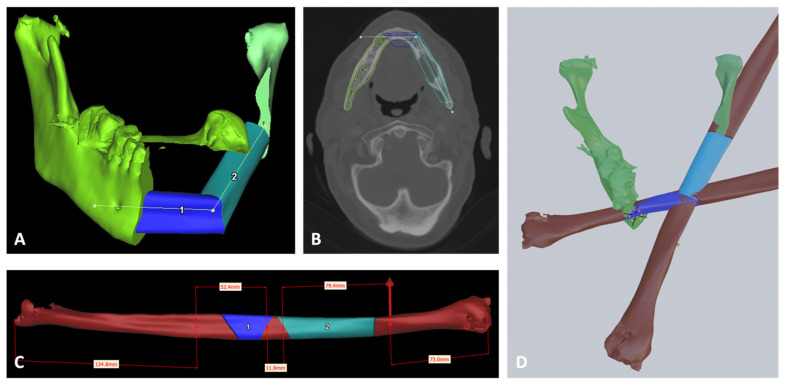 Training of Oral and Maxillofacial Surgery Residents in Virtual Surgical Planning: A Feasibility Study Comparing Open-Source Freeware and Commercially Available Software for Mandibular Reconstruction with Fibula Free Flap.